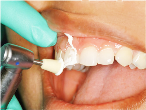 Teeth Cleaning, Dental Hygiene, Professional cleaning, Dentist, Hygienist, Whitening, Dr. Philip Aurbach, Old Hook Dental