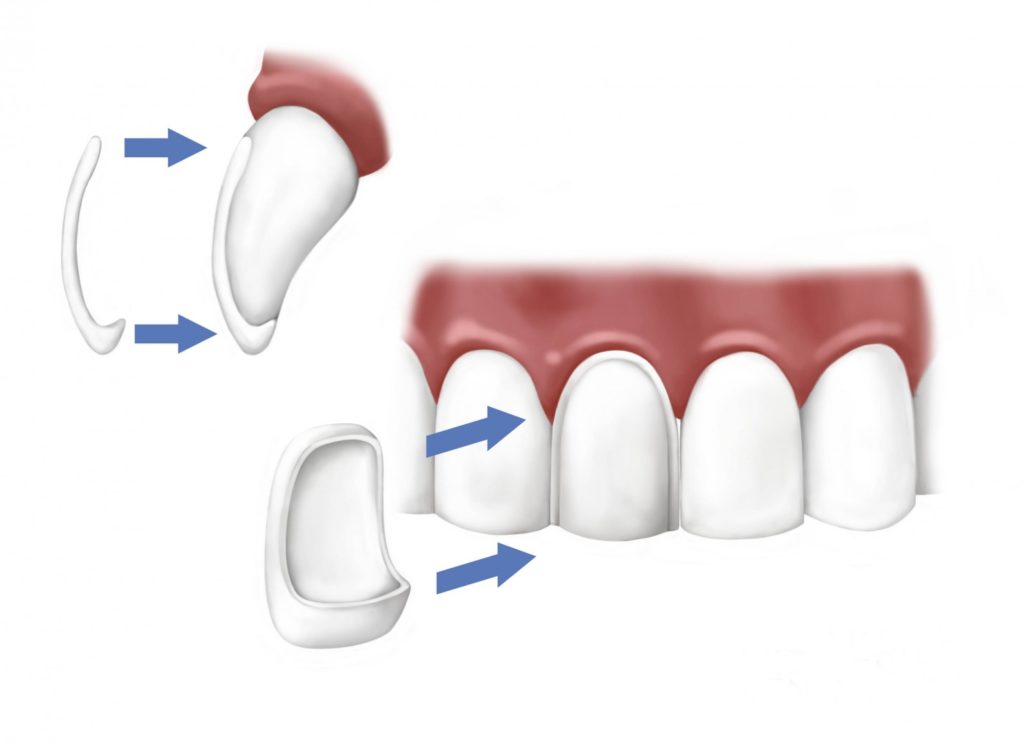 Dental veneers, Porcelain Veneers, Cosmetic, Dental make over, Ceramic, white teeth,