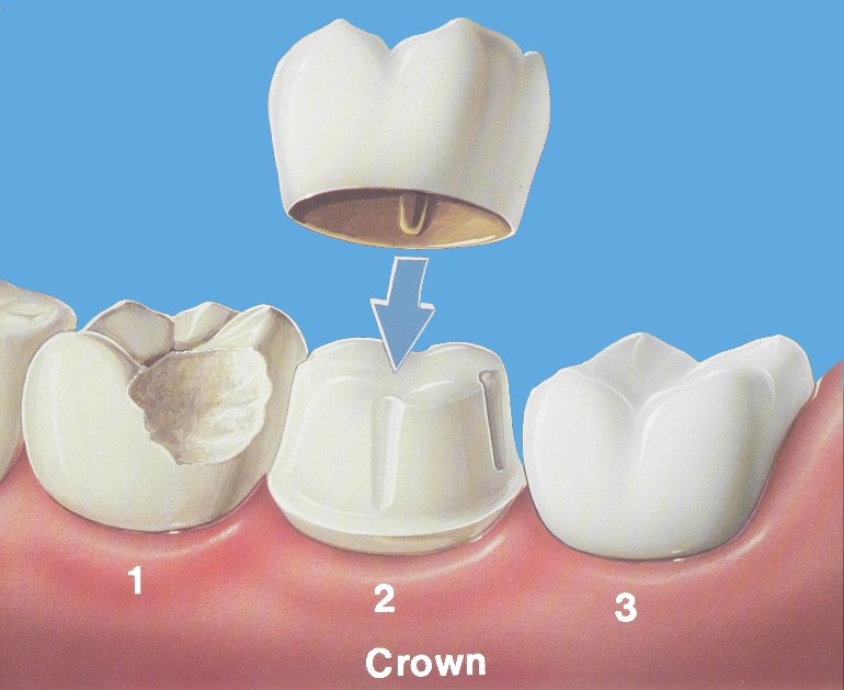Crown preparation, dental crown, dentist, tooth colored crown, tooth replacement
