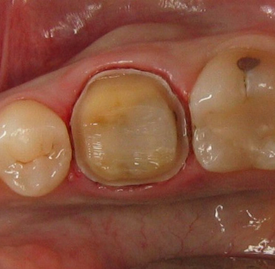 tooth preparation, crown preparation, tooth colored replacement, tooth crown