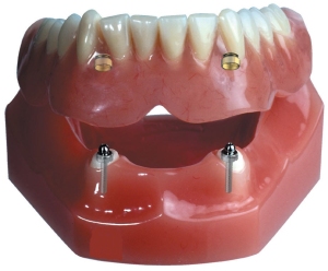 root overdenture, post denture, post supported denture, removable denture, tooth replacement