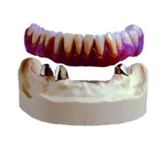 over denture, natural tooth over denture, overdenture, tooth retained denture, removable denture