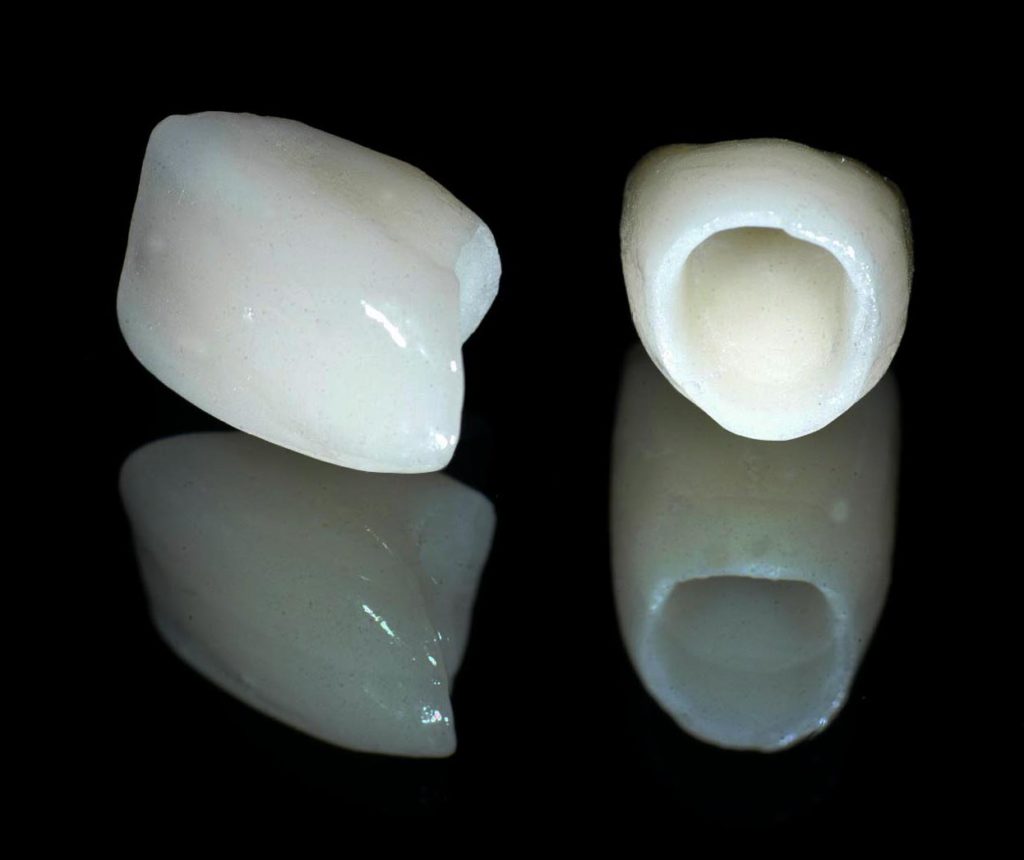 All porcelain crown, old hook dental, dentist nj, white tooth replacement, ceramic crown, all ceramic crown, tooth colored crown