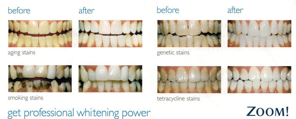 Teeth whitening, dental whitening, professional bleaching, zoom whitening, dentist office whitening