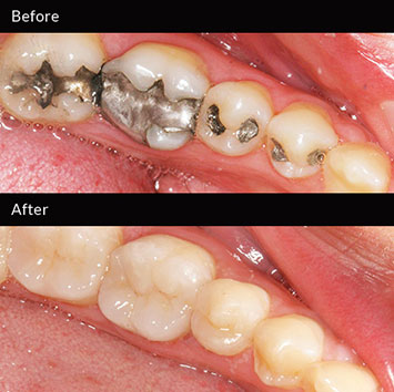 white filling, silver, amalgam, dental, tooth colored, composite, tooth restoration