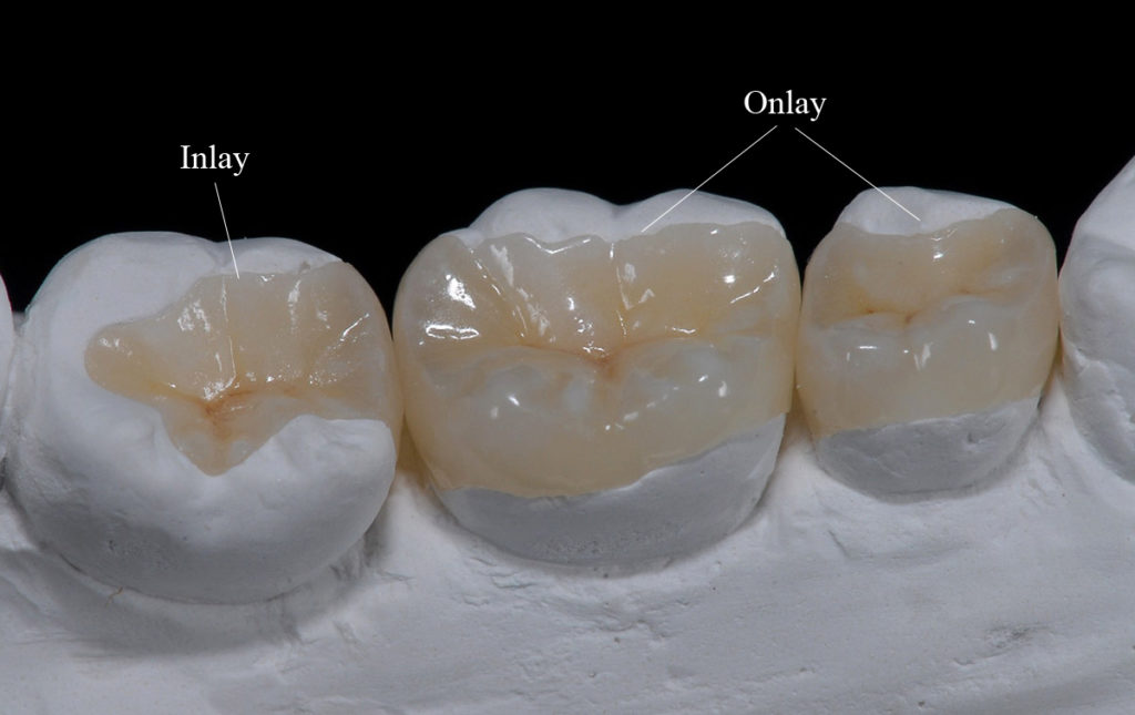 dental inlay Onlay, porcelain tooth, zirconia tooth, white tooth replacement, cavity filling
