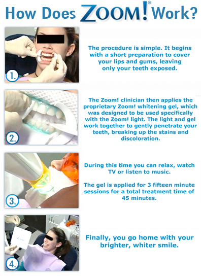 Zoom Dental whitening, teeth bleach, teeth cleaning, cosmetic dental, whiter smile