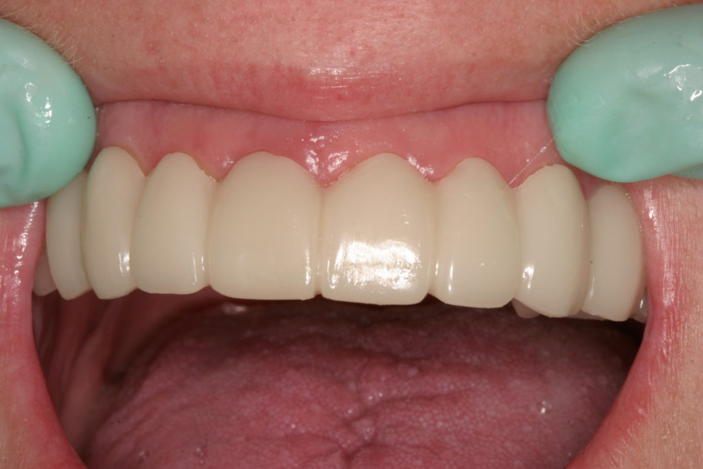 White teeth, dental whitening, cosmetic makeover, new teeth, veneers, bonding