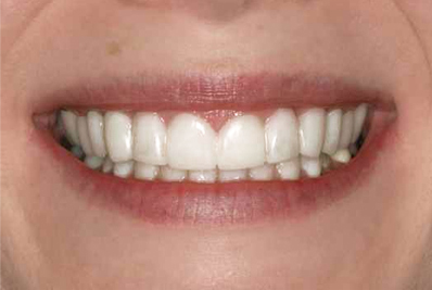 Veneers, Smile Make over, Hollywood Smile, Cosmetic dentistry, teeth whitening