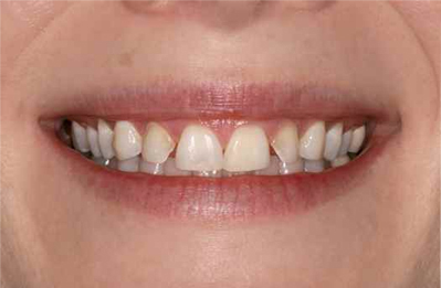 Snap on smile, Cosmetic dentistry Oradell, Veneers Closter, River Vale smile makeover, snap on veneers