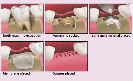 Grafting bone procedure, missing tooth, rebuild tooth, implant preparation, tooth preparation for implant, dental implants