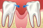 Tooth collapse, missing tooth, extracted tooth, tooth pulled, teeth falling