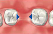 Tooth drifting, missing tooth, teeth collapse, tooth space, drifting teeth