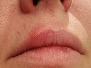 Canker Sore Treatment