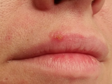 Canker Sore Treatment