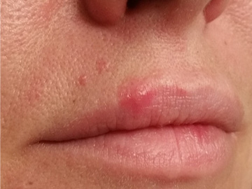 Cold Sore Treatment