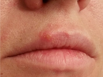 Cold sore on sale in nose treatment