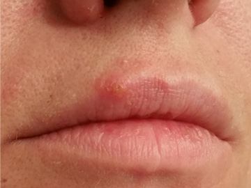 Cold Sore Treatment