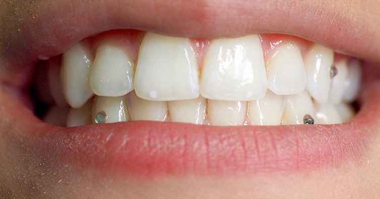 Tooth Gems and Tooth Jewelry - Westwood NJ Dentist