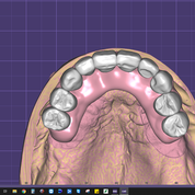 Dental Implant tooth Restoration