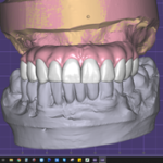 Dental Implant tooth Restoration