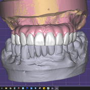 Dental Implant tooth Restoration