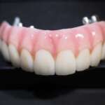 Dental Implant tooth Restoration