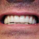 Dental Implant tooth Restoration