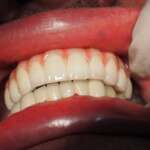 Dental Implant tooth Restoration