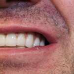 Dental Implant tooth Restoration