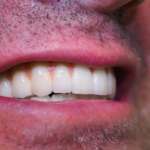 Dental Implant tooth Restoration