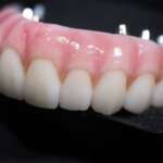 Dental Implant tooth Restoration