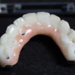 Dental Implant tooth Restoration