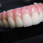 Dental Implant tooth Restoration