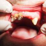 Dental Implant tooth Restoration