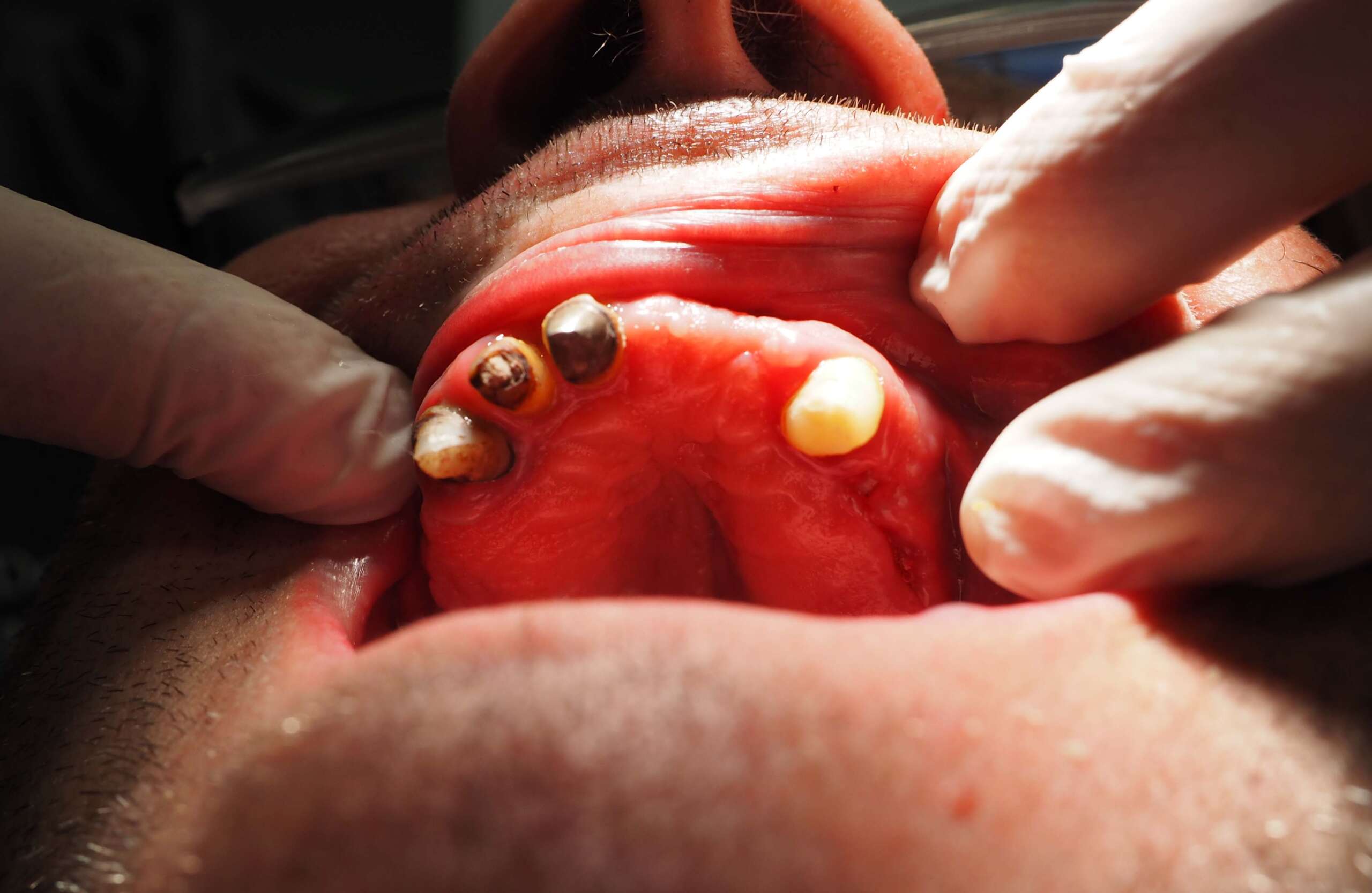 Dental Implant tooth Restoration