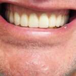 Dental Implant tooth Restoration