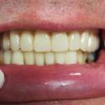 Dental Implant tooth Restoration