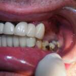 Dental Implant tooth Restoration