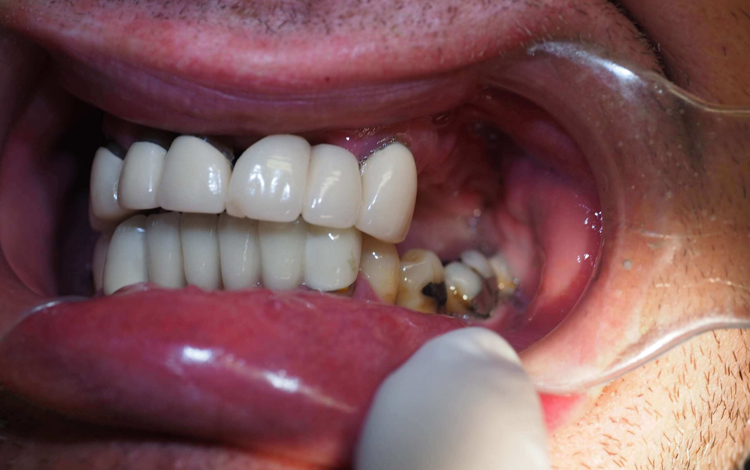 Dental Implant tooth Restoration