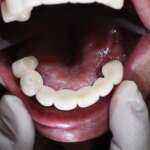 Dental Implant tooth Restoration