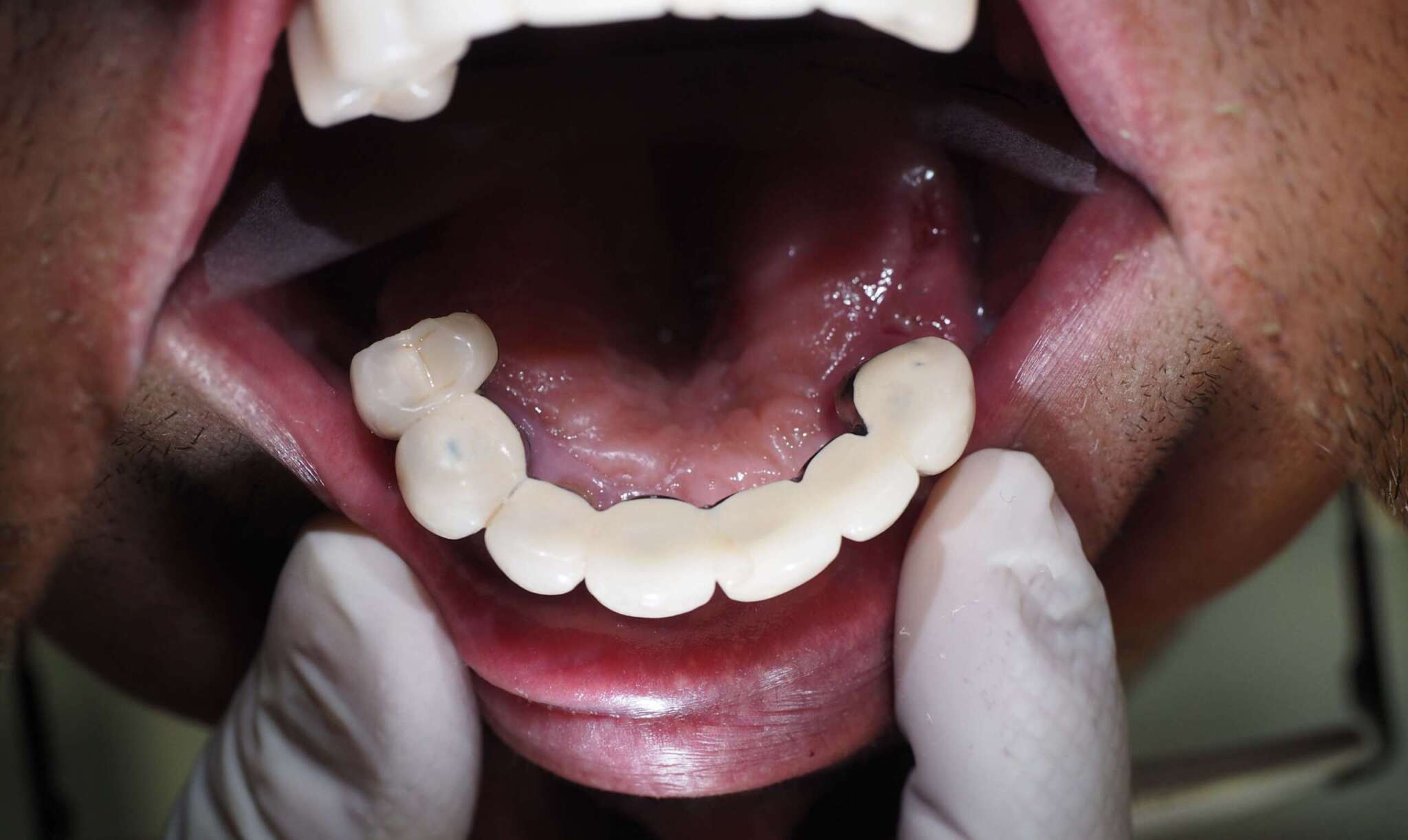 Dental Implant tooth Restoration