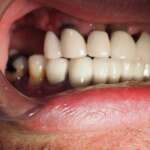 Dental Implant tooth Restoration