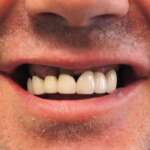 Dental Implant tooth Restoration