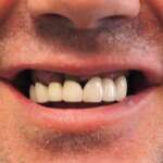 Dental Implant tooth Restoration