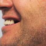 Dental Implant tooth Restoration