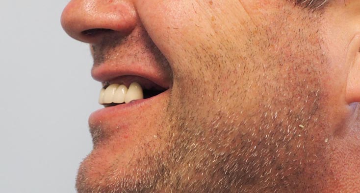 Dental Implant tooth Restoration