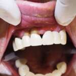 Dental Implant tooth Restoration