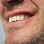 Dental Implant tooth Restoration