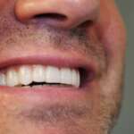 Dental Implant tooth Restoration